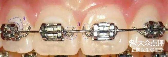 正畸八字结扎丝-图2