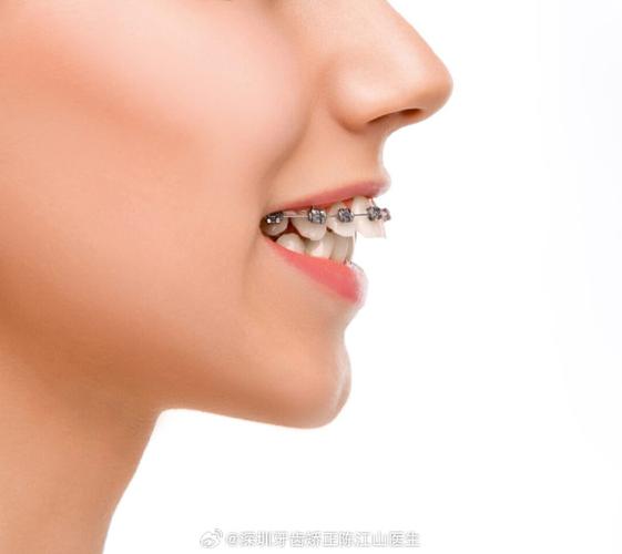 正畸2x4覆盖-图1 正畸2x4覆盖-图1