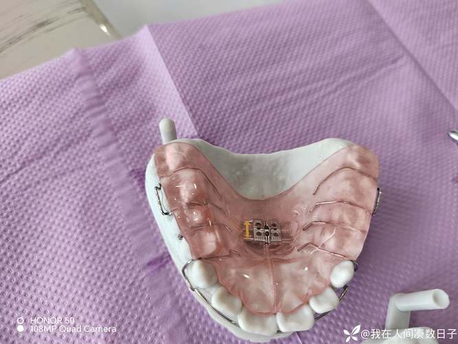 Tb正畸矫治器-图1