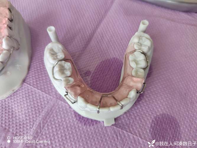 Tb正畸矫治器-图2