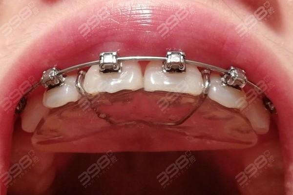 正畸固定式平导-图3