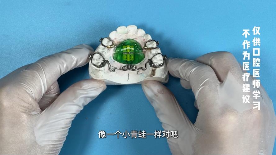 正畸摆氏矫治器-图1