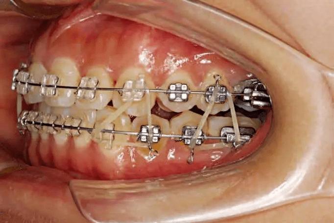 正畸牵引钩扎嘴-图2