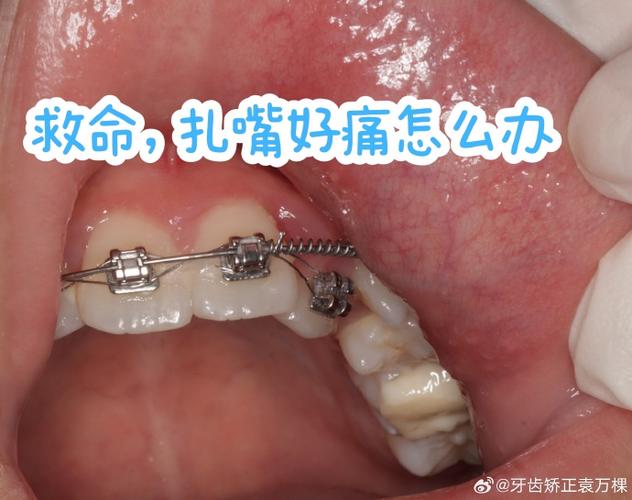 正畸牵引钩扎嘴-图3