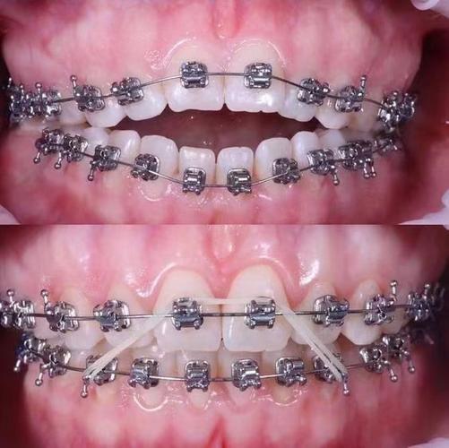 正畸矫正时铁丝两边跑是什么原因？需要怎么处理？-图1