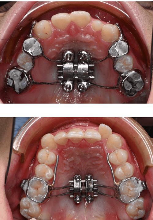颌骨正畸矫正器-图3