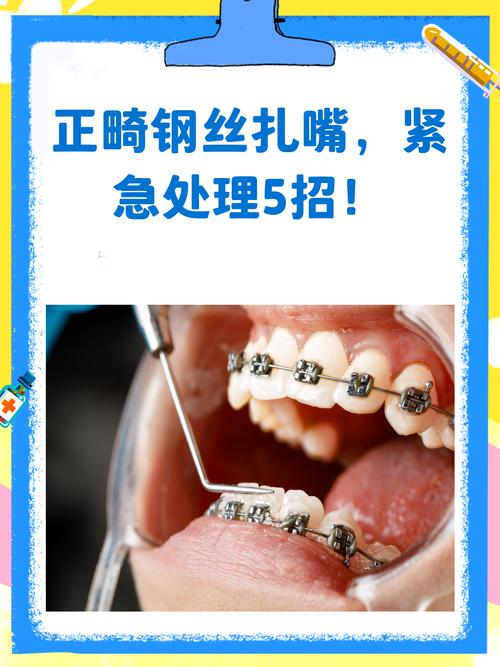 正畸八字结扎图-图3