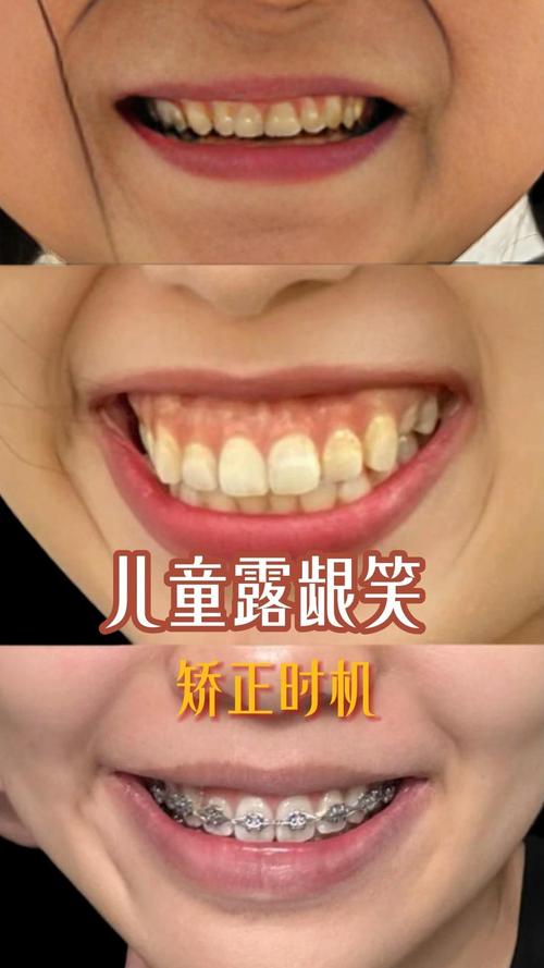 正畸整成露龈笑-图1