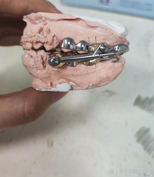 正畸咬椅的弯制-图3