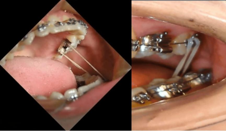 可摘牵引钩正畸-图3