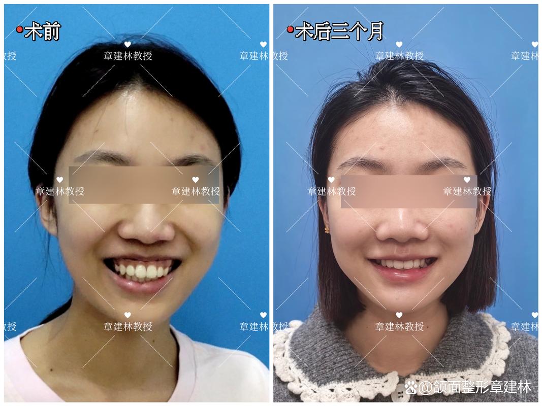 骨性露龈笑正畸矫正效果如何？-图1