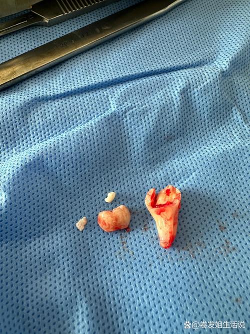 正畸拔了八个牙-图2