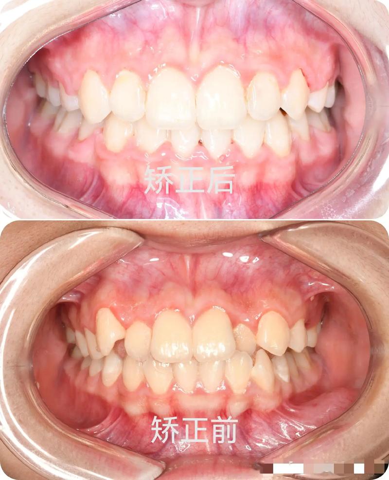 拔了一个牙正畸-图1