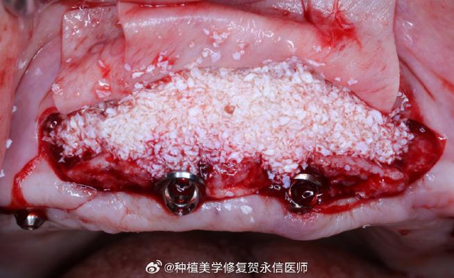 正畸骨钉有脓液是怎么回事?需要怎么处理?-图1 正畸骨钉有脓液是怎么回事?需要怎么处理?-图1