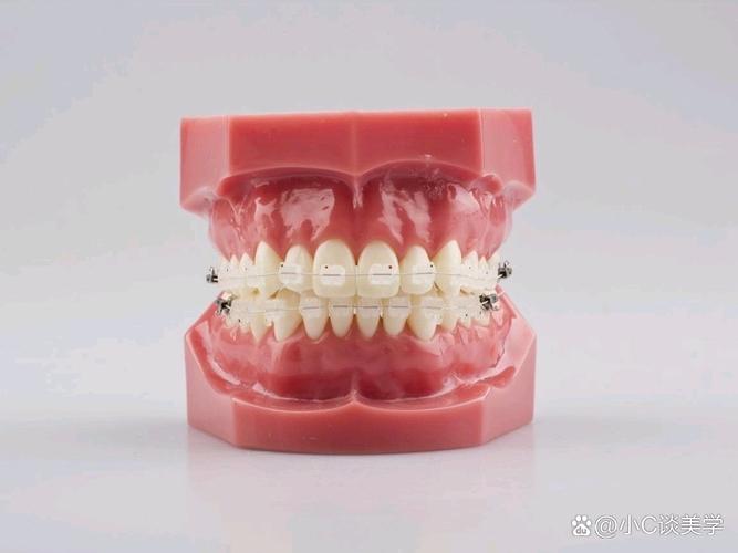 正畸为何单独买一个托槽？有什么讲究吗？-图3