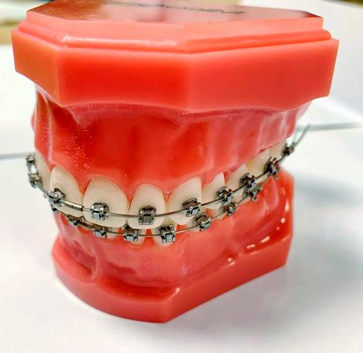 正畸为何单独买一个托槽？有什么讲究吗？-图1