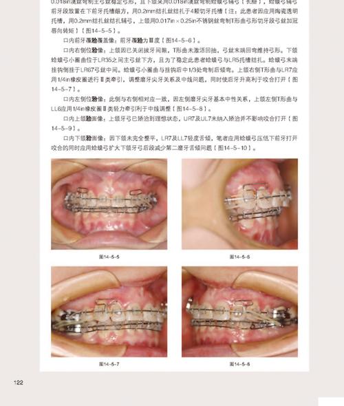 武广增正畸实用-图1