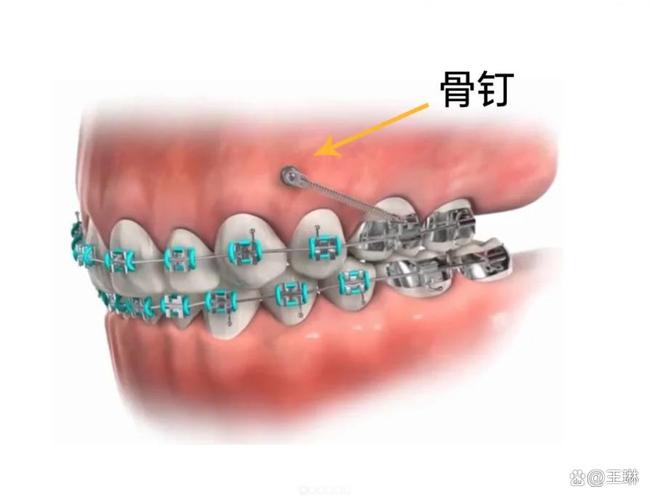 上颌骨打钉正畸-图1