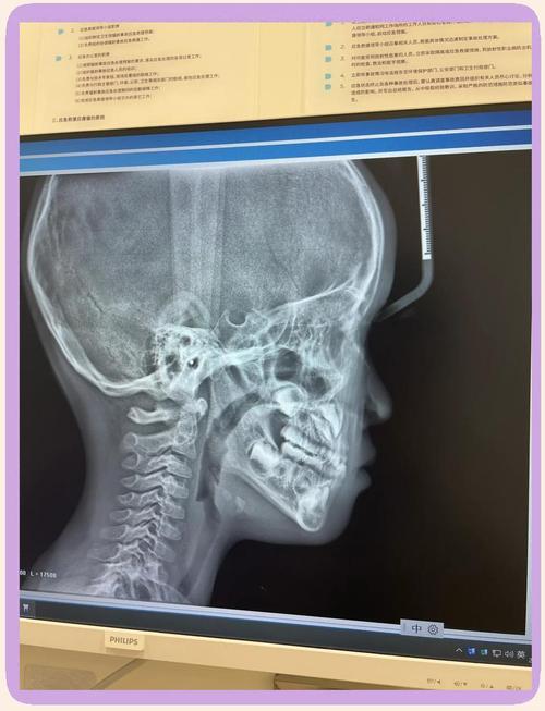 正畸治疗对颅颌面发育的作用机制何在？-图1