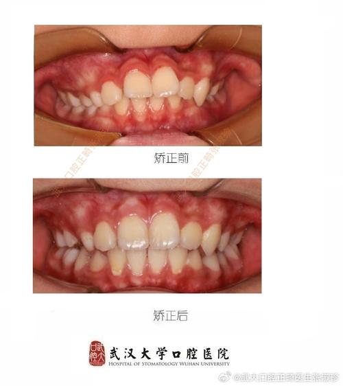 正畸治疗对颅颌面发育的作用机制何在？-图3