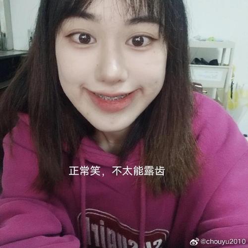 正畸牙弓变窄了-图1 正畸牙弓变窄了-图1