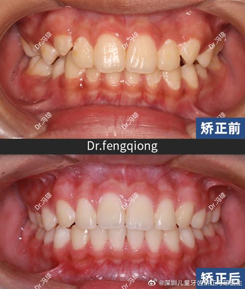 正畸牙弓变窄了-图3 正畸牙弓变窄了-图3