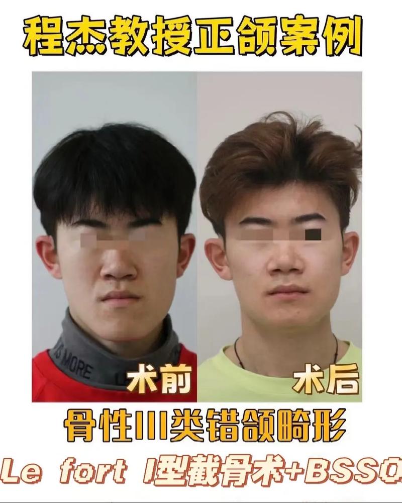 王雪东正畸案例-图1