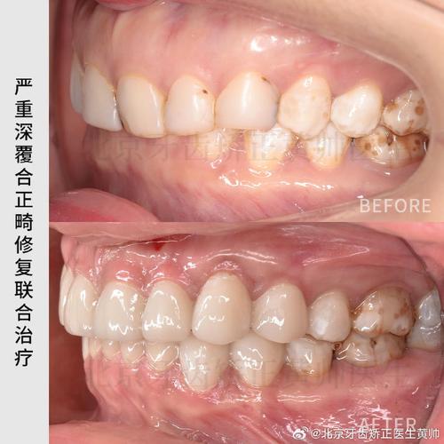 王雪东正畸案例-图3