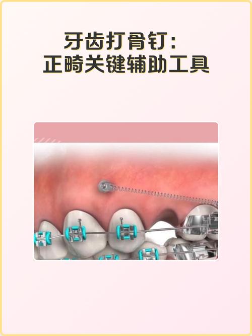 正畸种植钉误吞-图3