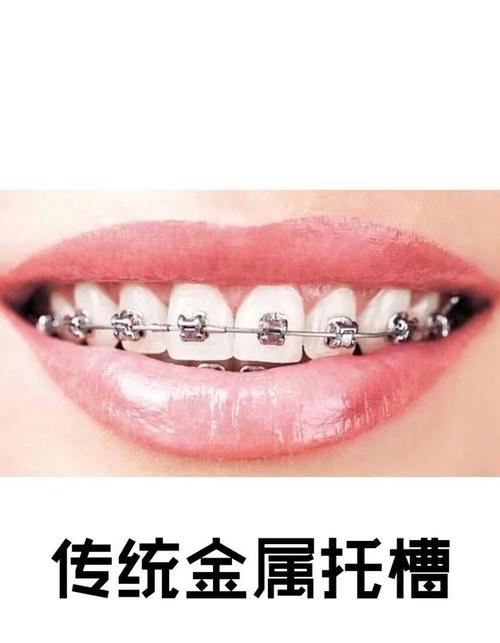 双弓丝正畸托槽-图3
