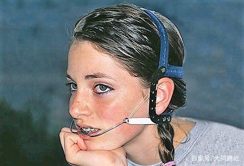 正畸J钩的戴法-图1 正畸J钩的戴法-图1