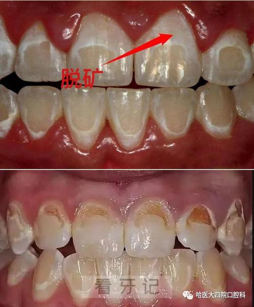 正畸过程牙脱矿-图1