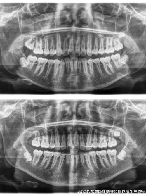正畸侧位片是什么？为何正畸诊断离不开它？如何解读？-图1
