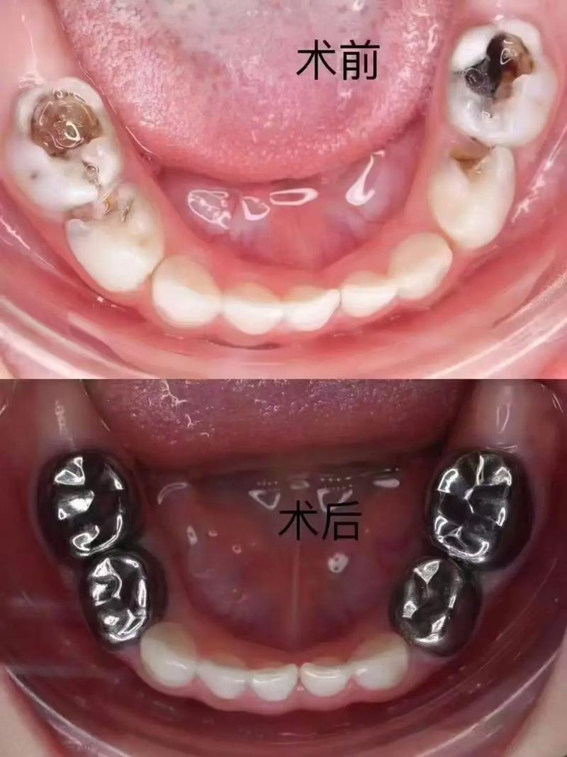 口腔正畸预成冠-图1 口腔正畸预成冠-图1