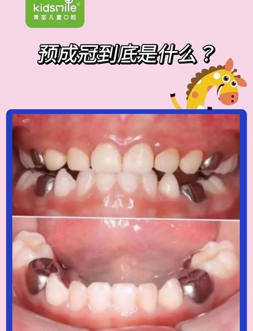 口腔正畸预成冠-图2 口腔正畸预成冠-图2