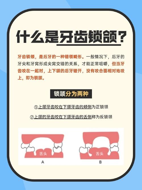 锁颌不能正畸吗-图1 锁颌不能正畸吗-图1