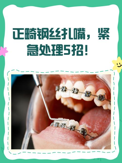 正畸单扎是什么？单颗牙齿矫正的新选择？-图1