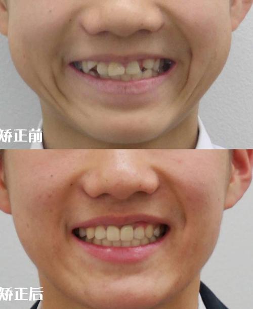 正畸3号牙后移-图1 正畸3号牙后移-图1