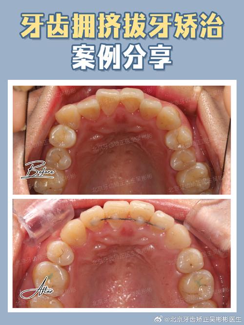 正畸3号牙后移-图2 正畸3号牙后移-图2