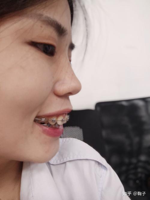 口腔正畸拍照片-图1