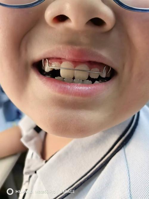 正畸矫正小孩子-图1 正畸矫正小孩子-图1