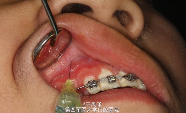 外科正畸导萌术-图1 外科正畸导萌术-图1