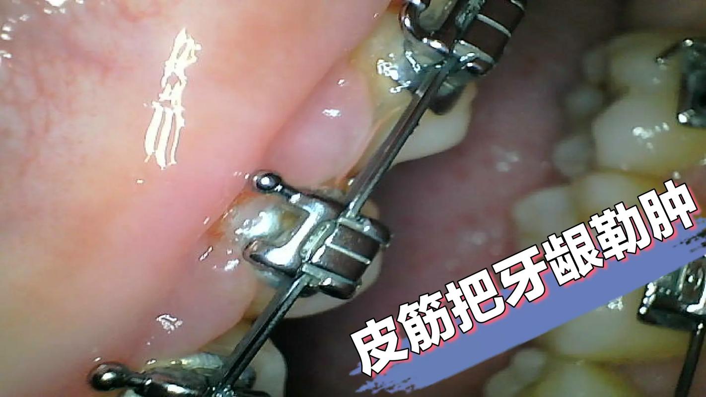 正畸牙掏根创伤-图1