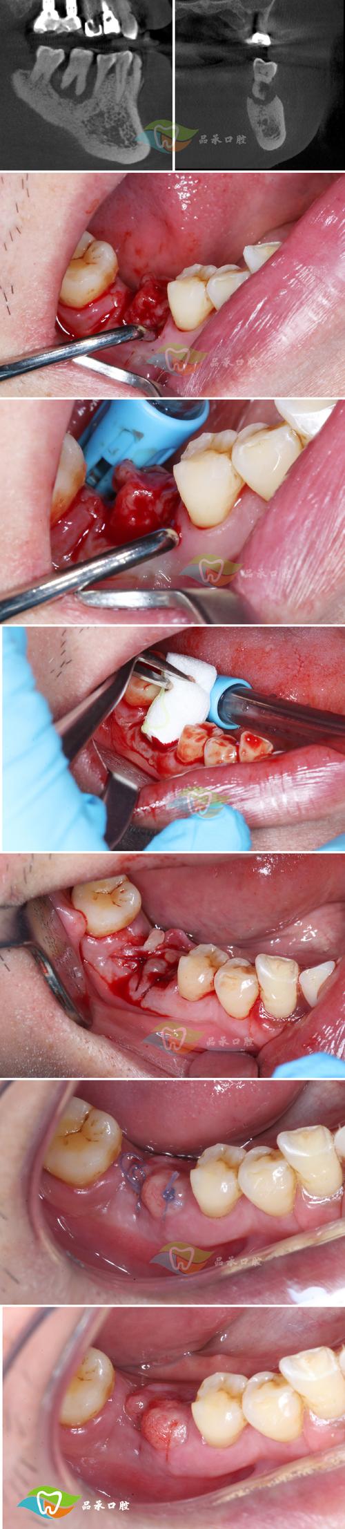 正畸牙掏根创伤-图2