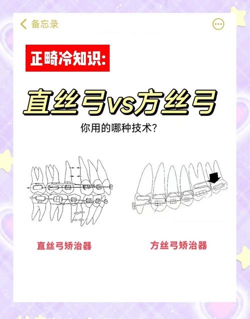 正畸弓丝的使用-图2