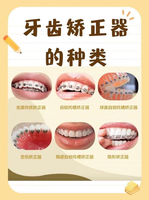 正畸自锁托槽图-图3