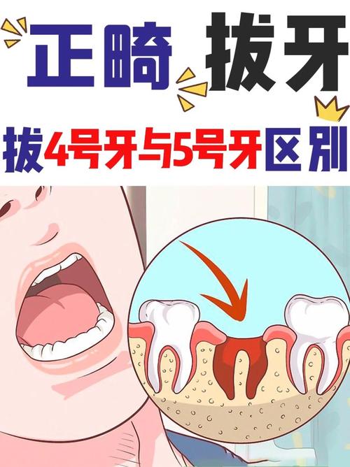 正畸拔牙4个5-图1 正畸拔牙4个5-图1