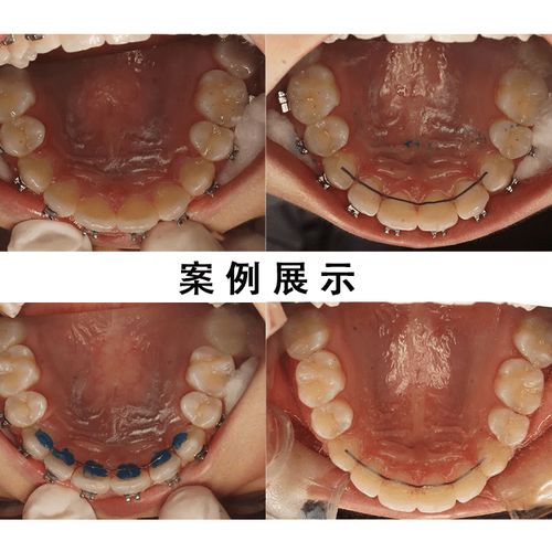 正畸六股麻花丝-图2 正畸六股麻花丝-图2