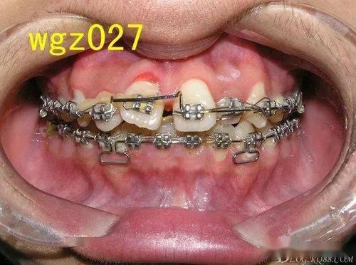 中切牙间隙正畸-图3