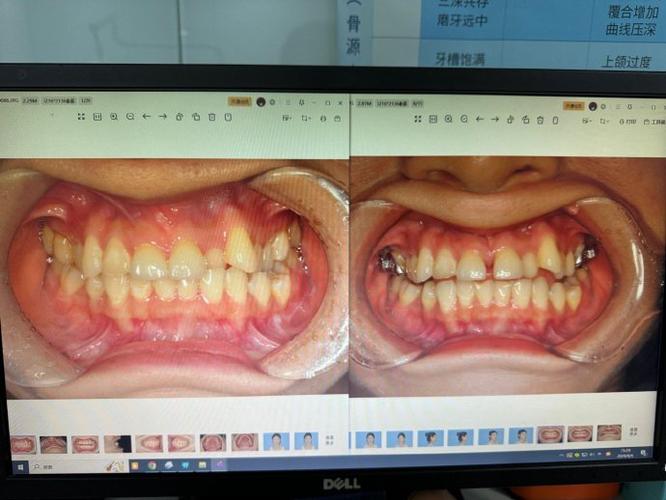 正畸扩弓腭中缝-图1